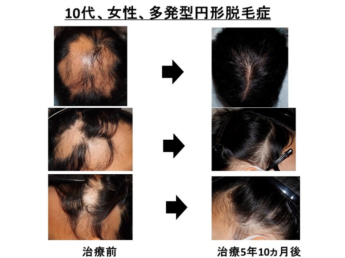 円形脱毛症　病院